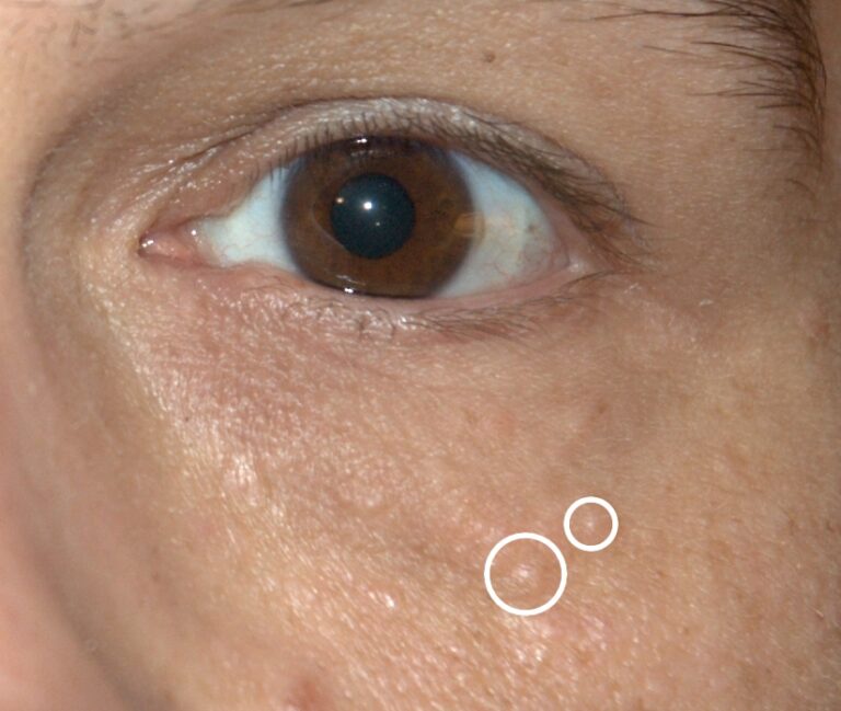 Multiple small skin-colored bumps below an eye, with syringomas circled by the original photographer.
