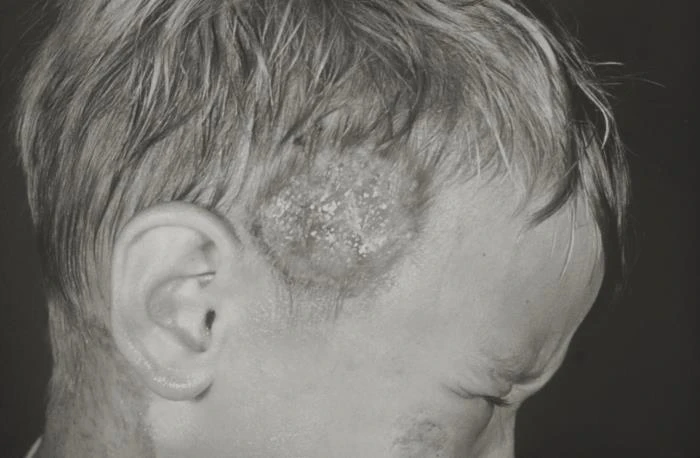 Historical clinical photograph showing a crusted kerion near a child's temple and additional nearby skin lesions