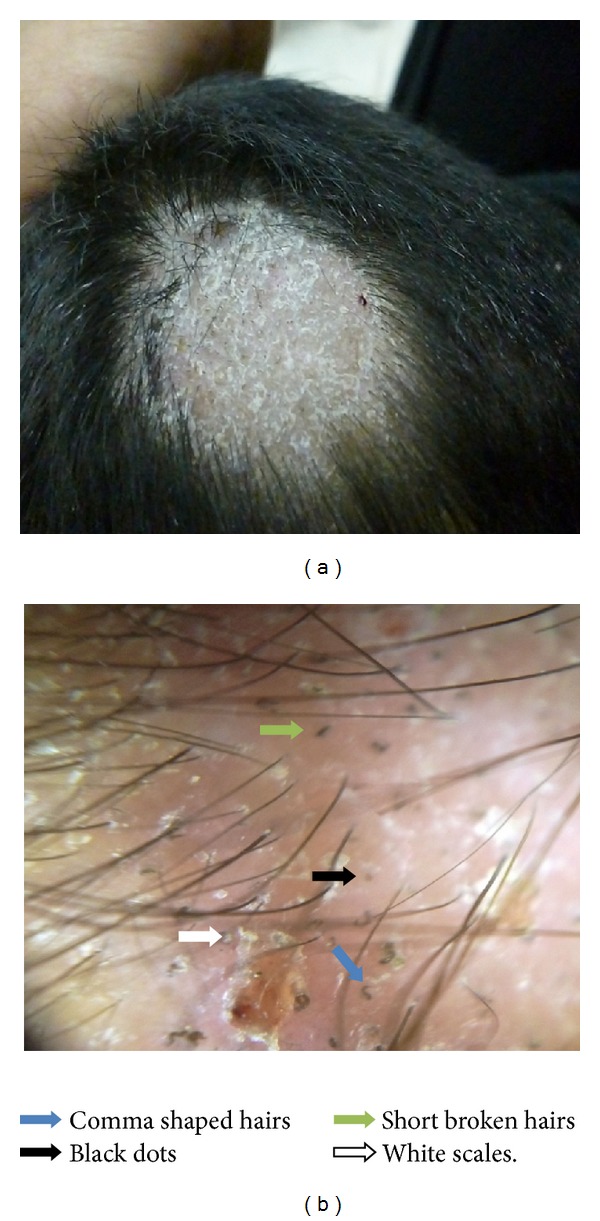 Clinical scalp photograph and 20× magnified view of tinea capitis, with arrows identifying short broken hairs, black dots, comma-shaped hairs and scales.