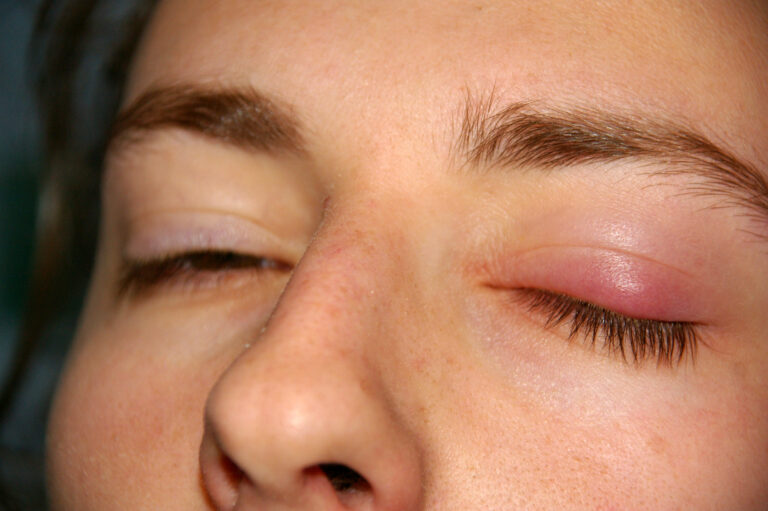 A swollen, reddish lump in the upper eyelid in a photograph of a chalazion.