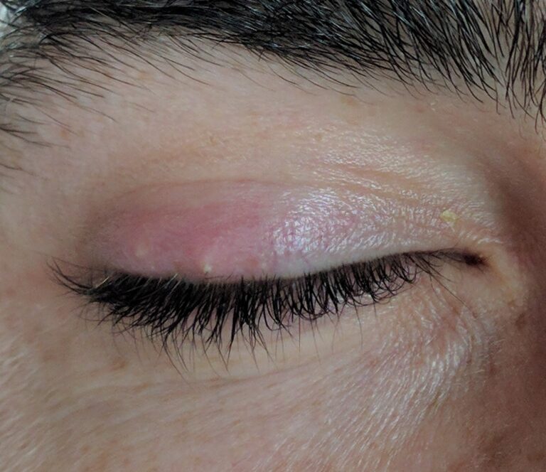 Localized red swelling of the upper eyelid in a photograph of a stye.