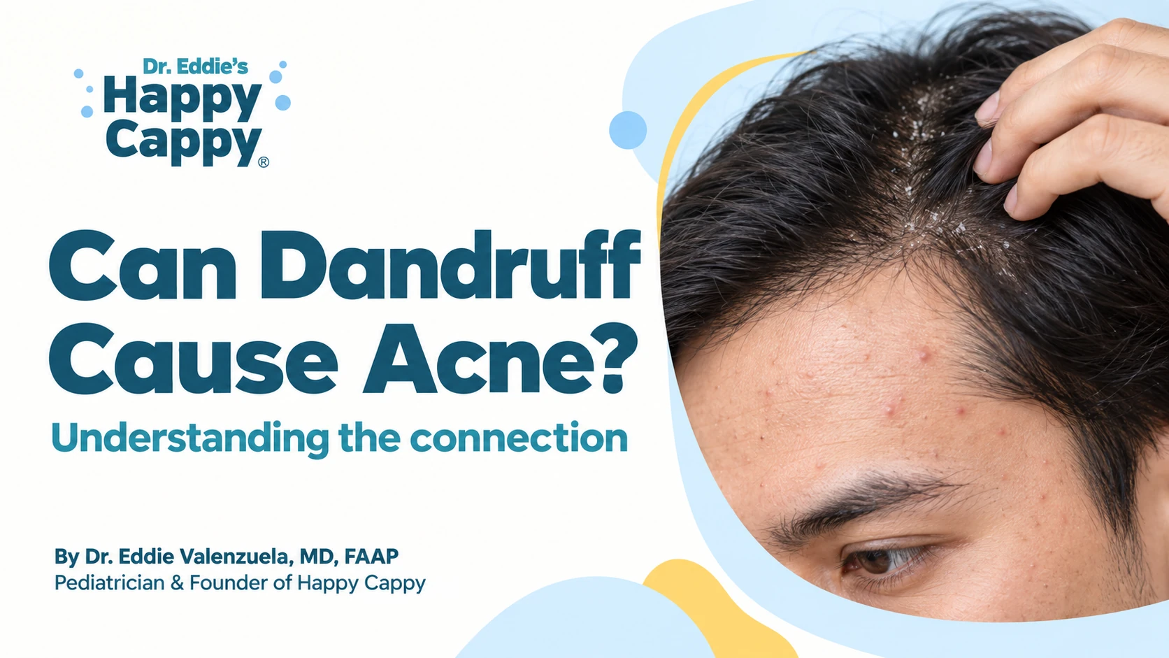 Can Dandruff Cause Acne? And How To Get Rid Of It?