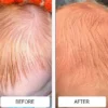 Severe baby acne on a newborn's face around the eyes before and much clearer skin after