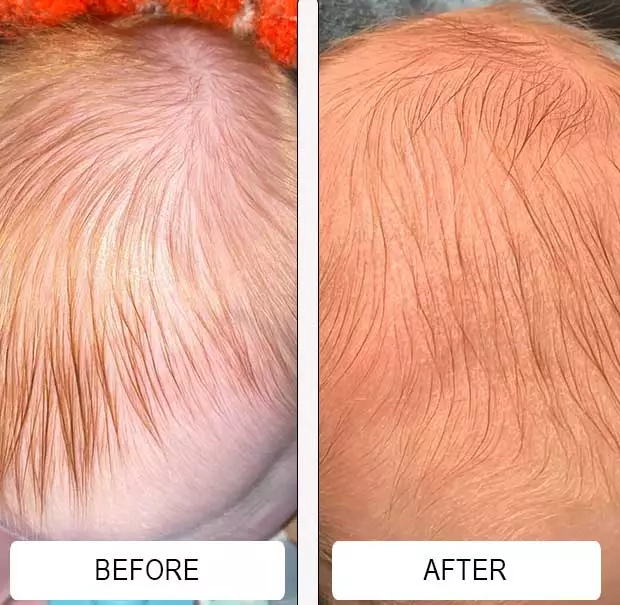 Severe baby acne on a newborn's face around the eyes before and much clearer skin after