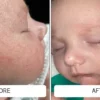 A newborn's baby acne bumps on the cheek before and clearer skin after two weeks