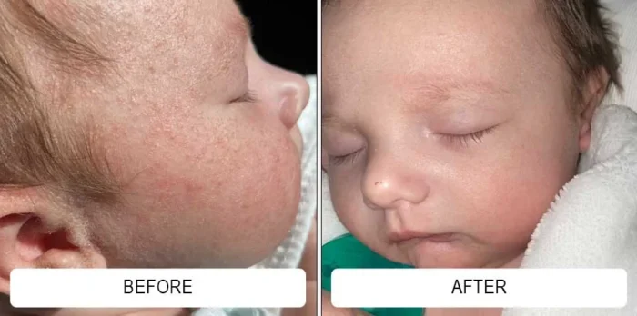 A newborn's baby acne bumps on the cheek before and clearer skin after two weeks