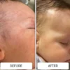 Cheek redness and baby acne on a newborn before and calmer skin in the after photo