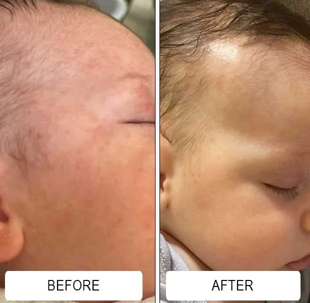 Cheek redness and baby acne on a newborn before and calmer skin in the after photo