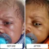 Baby acne bumps on a newborn's forehead before and clearer skin after