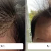 Baby acne bumps across a newborn's forehead before and smoother skin after