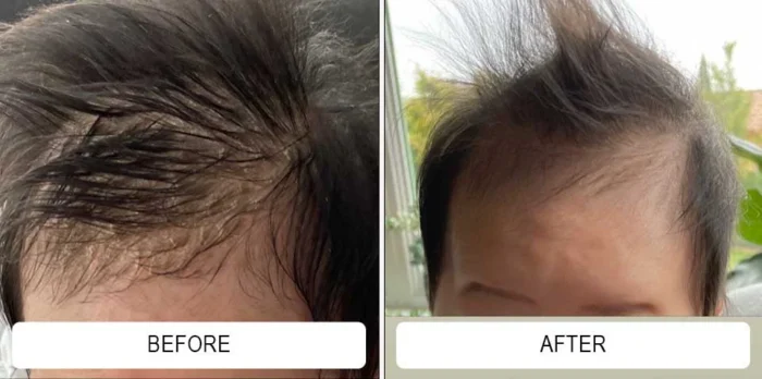 Baby acne bumps across a newborn's forehead before and smoother skin after