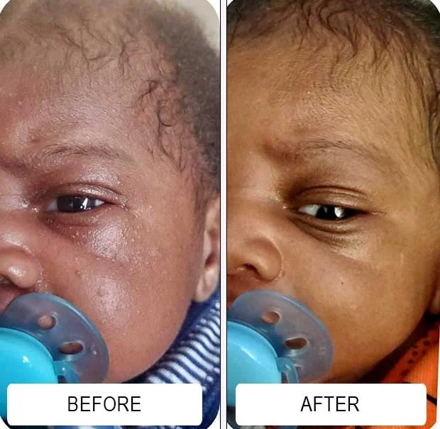 Baby acne bumps on a newborn's forehead before and clearer skin after