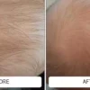 A newborn's inflamed facial baby acne before and calm, clear skin after