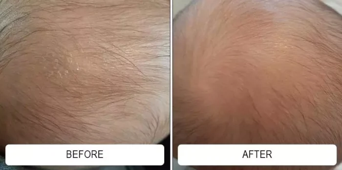 A newborn's inflamed facial baby acne before and calm, clear skin after