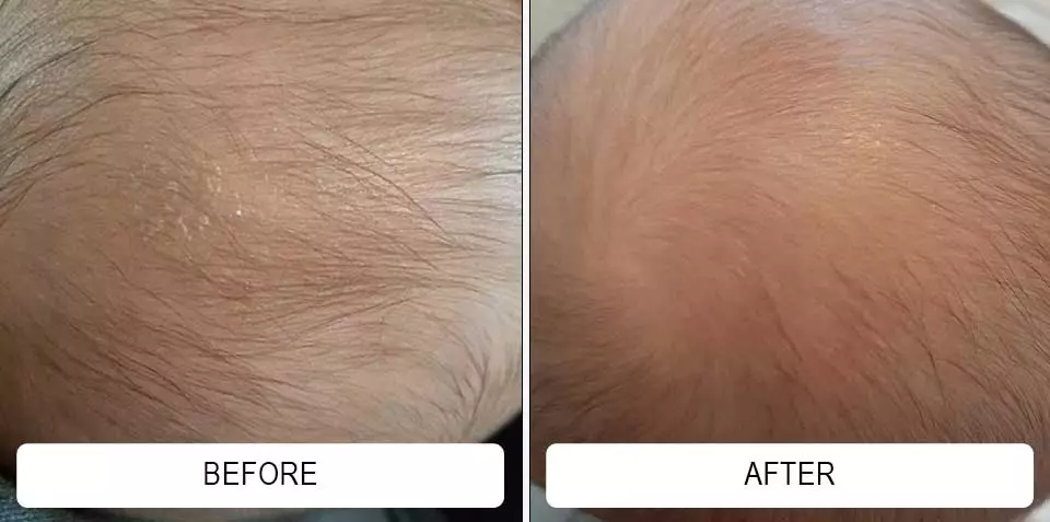 Fine scalp flakes in before-and-after photographs