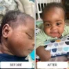 A newborn's facial baby acne before and clearer skin in the after photo