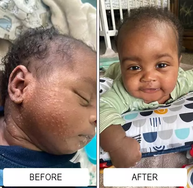 A newborn's facial baby acne before and clearer skin in the after photo