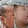 A newborn's baby acne on the face before and clearer skin roughly a week later