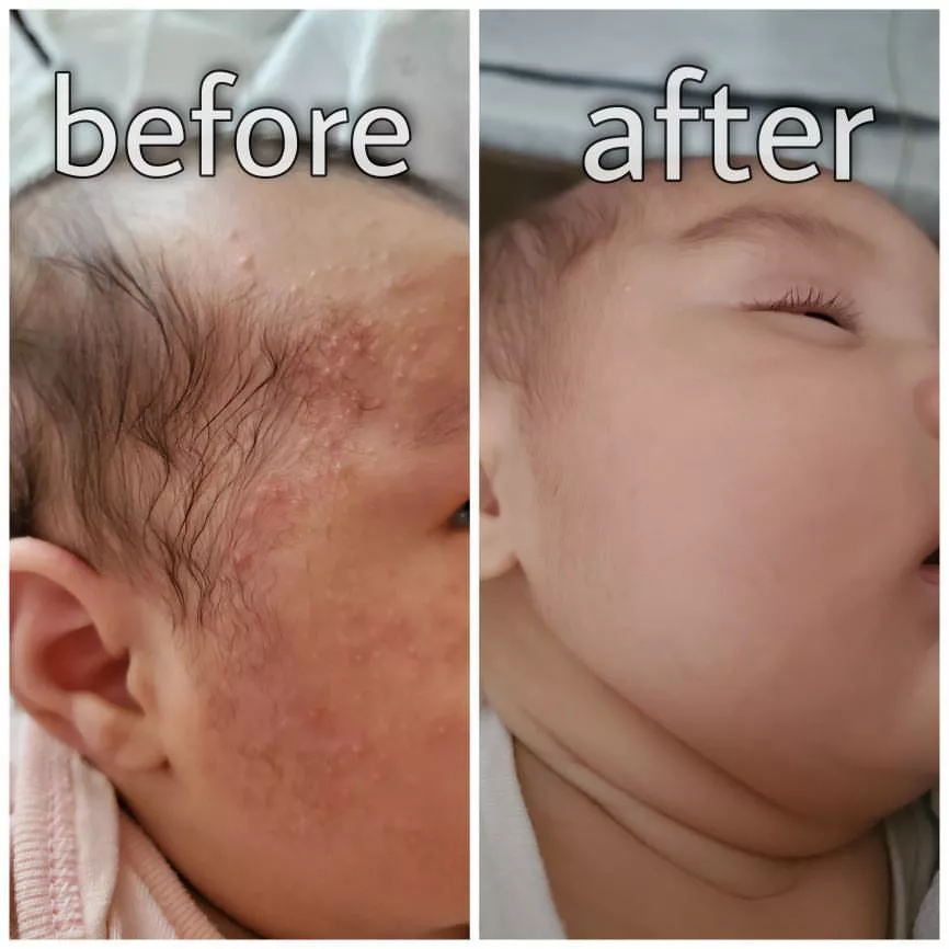 A newborn’s facial skin in before-and-after photographs
