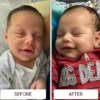 A newborn's facial baby acne before and clearer, smiling skin after about a week