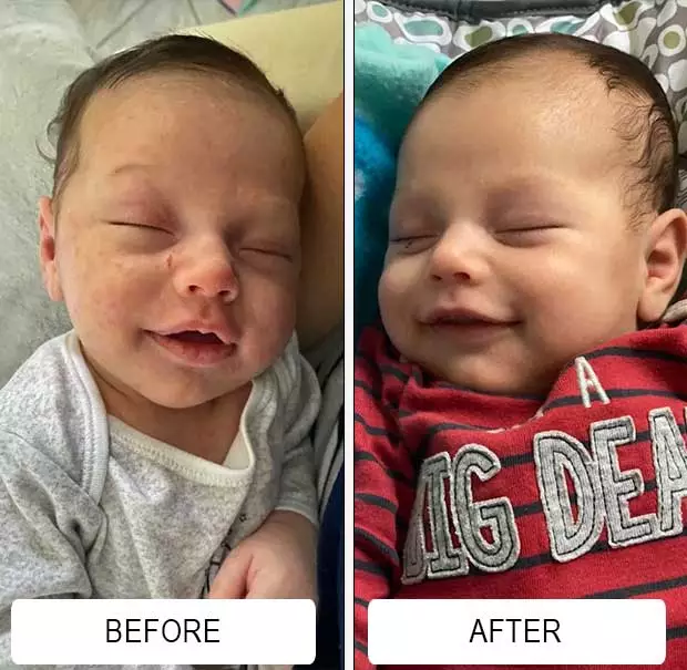 A newborn's facial baby acne before and clearer, smiling skin after about a week