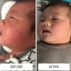 A baby's red, bumpy facial acne on the cheeks before and clearer skin after about two weeks