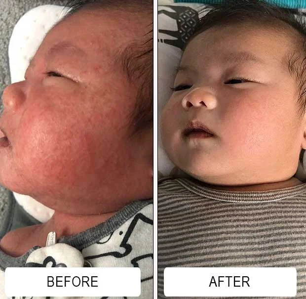 A baby's red, bumpy facial acne on the cheeks before and clearer skin after about two weeks