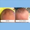 Cradle cap flaking across a baby's crown before and after two weeks of Happy Cappy medicated shampoo
