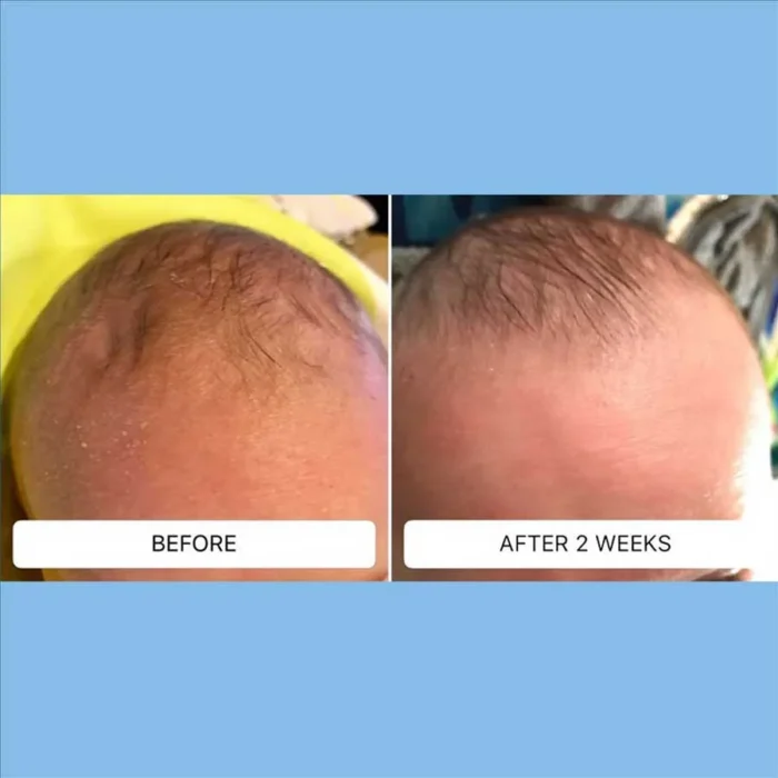 Cradle cap flaking across a baby's crown before and after two weeks of Happy Cappy medicated shampoo