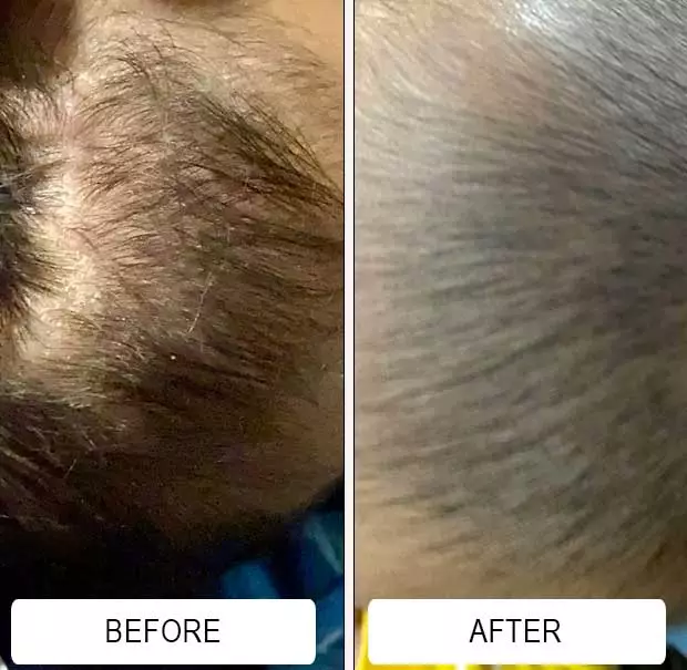 Cradle cap flakes in a baby's dark hair before and after two weeks of Happy Cappy medicated shampoo