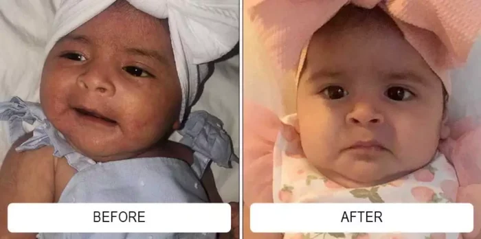 Fine cradle cap flakes on a baby's scalp before and a clear scalp after Happy Cappy medicated shampoo