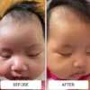 Cradle cap along a baby's forehead and hairline before and after using Happy Cappy medicated shampoo