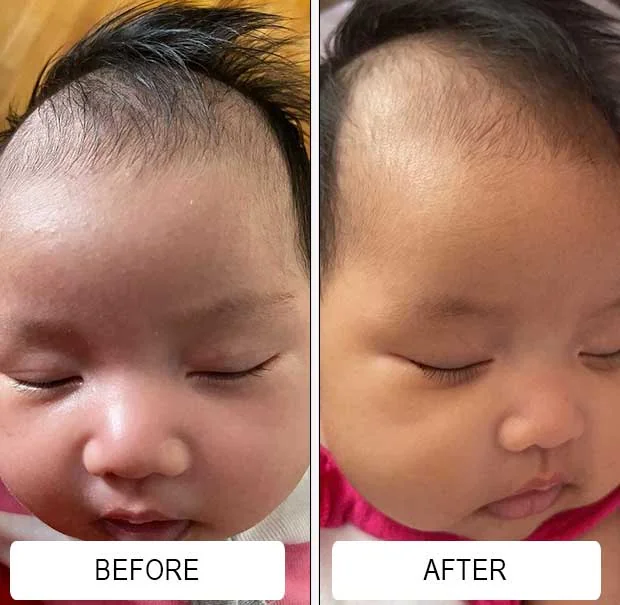 Cradle cap along a baby's forehead and hairline before and after using Happy Cappy medicated shampoo