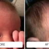 Redness and flaking on a baby's forehead and hairline before and clearer skin after Happy Cappy medicated shampoo