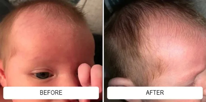 Redness and flaking on a baby's forehead and hairline before and clearer skin after Happy Cappy medicated shampoo