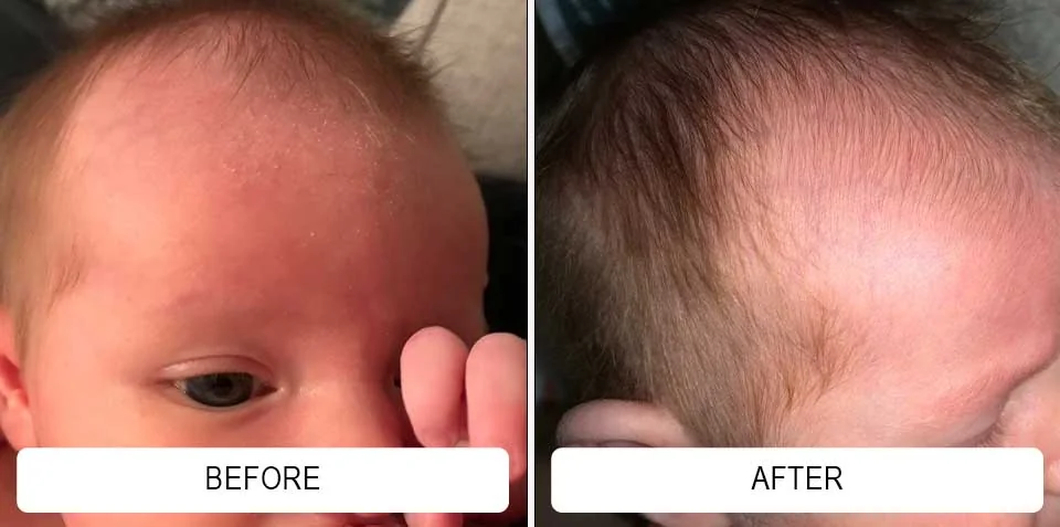 Forehead and hairline redness in before-and-after photographs
