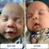 A greasy, flaky cradle cap scalp before and a clearer scalp after Happy Cappy medicated shampoo