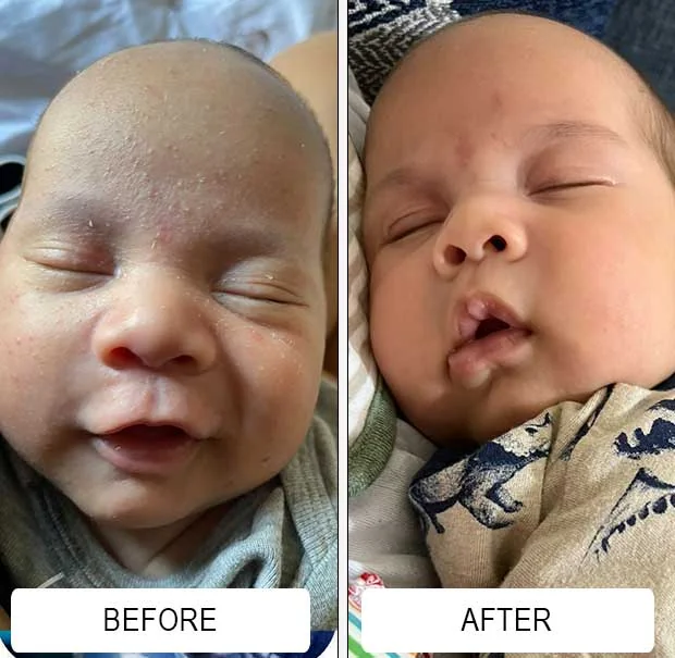 A greasy, flaky cradle cap scalp before and a clearer scalp after Happy Cappy medicated shampoo