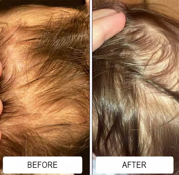 Cradle cap flakes near a baby's hairline before and a clear scalp after using Happy Cappy medicated shampoo