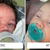 Cradle cap flaking on a pale baby scalp before and a smooth scalp after Happy Cappy medicated shampoo