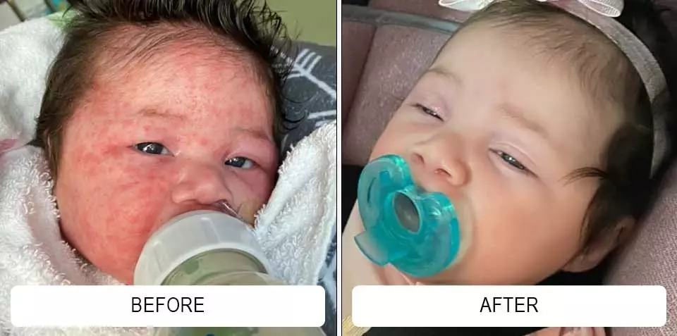 Facial bumps and redness in before-and-after photographs
