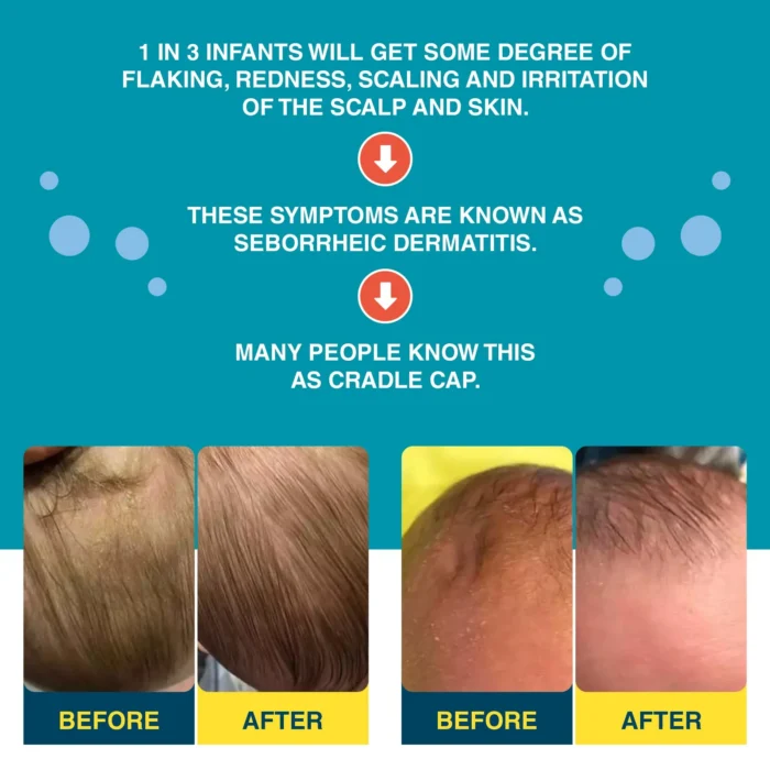 Two cradle cap before and after scalp comparisons, with a note that these symptoms are seborrheic dermatitis