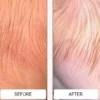 Close-up of a baby's scalp with cradle cap redness before and after Happy Cappy medicated shampoo
