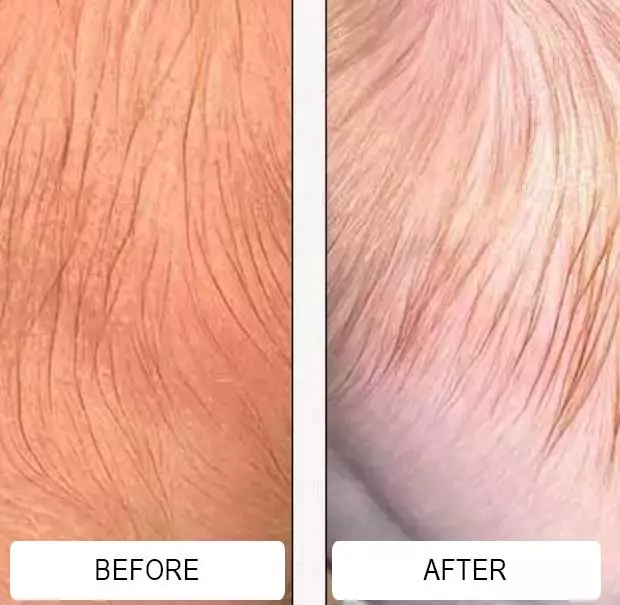 Close-up of a baby's scalp with cradle cap redness before and after Happy Cappy medicated shampoo