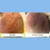 A baby's scalp redness and scaling from cradle cap before and after two weeks with Happy Cappy medicated shampoo