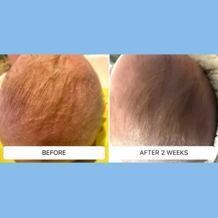 A baby's scalp redness and scaling from cradle cap before and after two weeks with Happy Cappy medicated shampoo