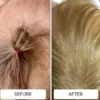A baby's flaking, scaling scalp from cradle cap before and after two weeks of Happy Cappy medicated shampoo