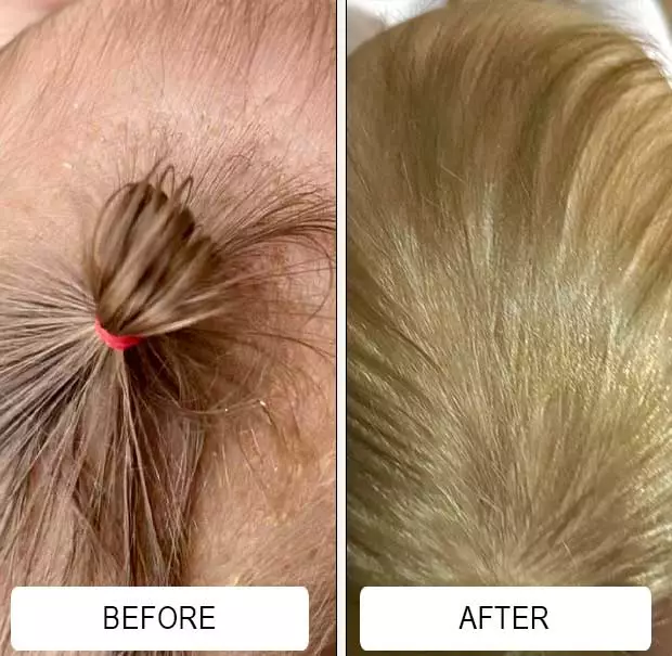 A baby's flaking, scaling scalp from cradle cap before and after two weeks of Happy Cappy medicated shampoo