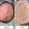 A scaly, red cradle cap scalp before and a clear scalp after using Happy Cappy medicated shampoo