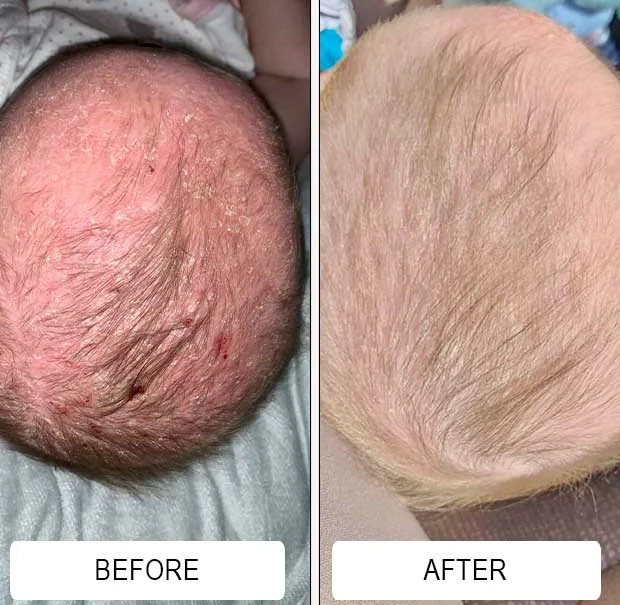A scaly, red cradle cap scalp before and a clear scalp after using Happy Cappy medicated shampoo